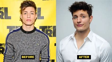 matt rife before cosmetic surgery|matt rife before and now.